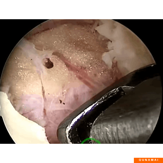 UBE-UBE-Keyhole Anatomical Layers (High Definition) AYDEFY